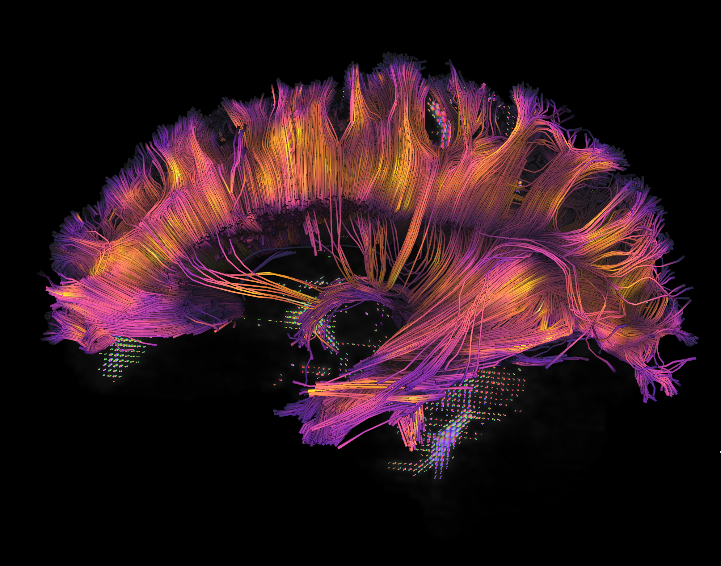 Diffusion imaging brain scan
