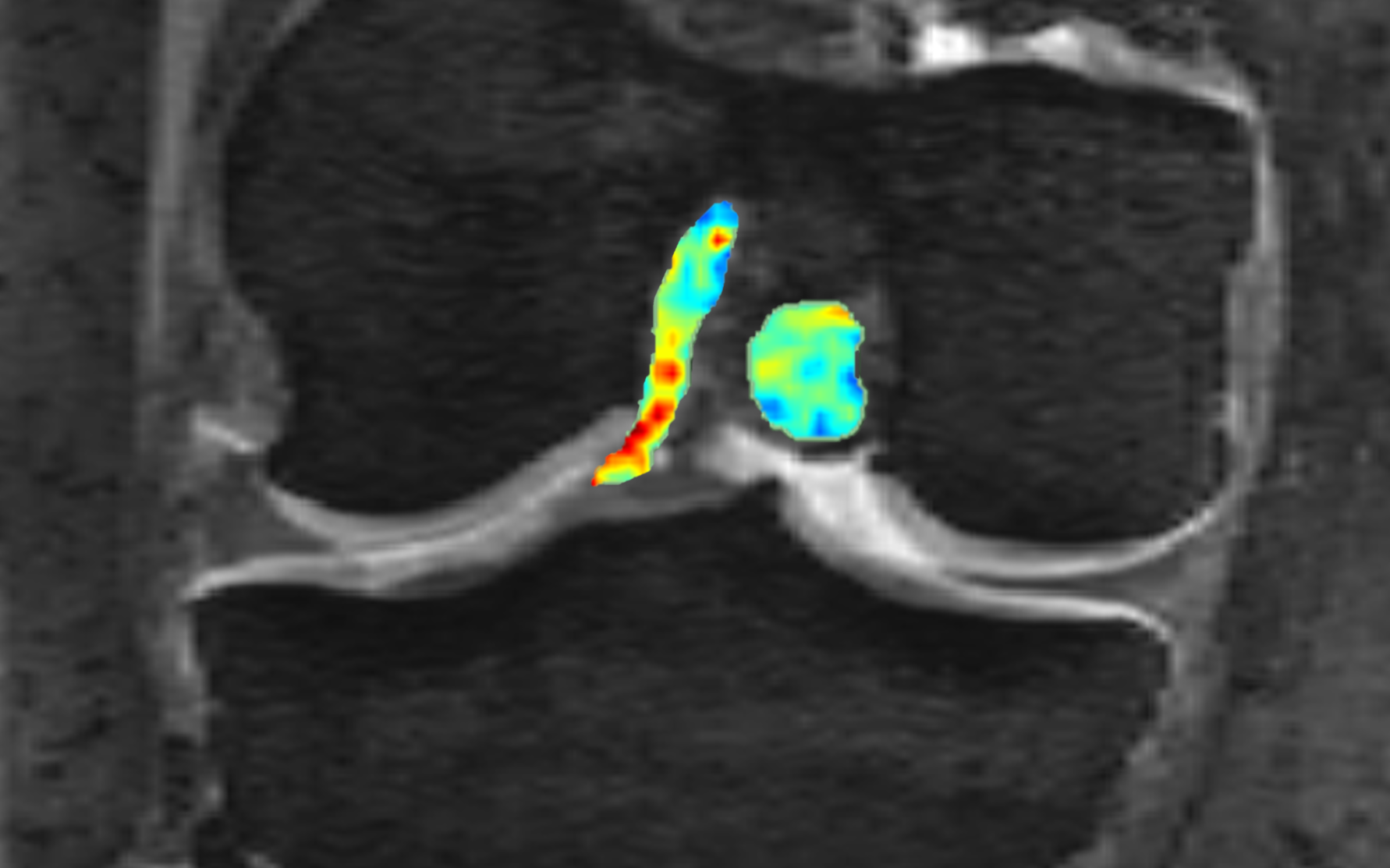 Cropped coronal MRI scan of the knee