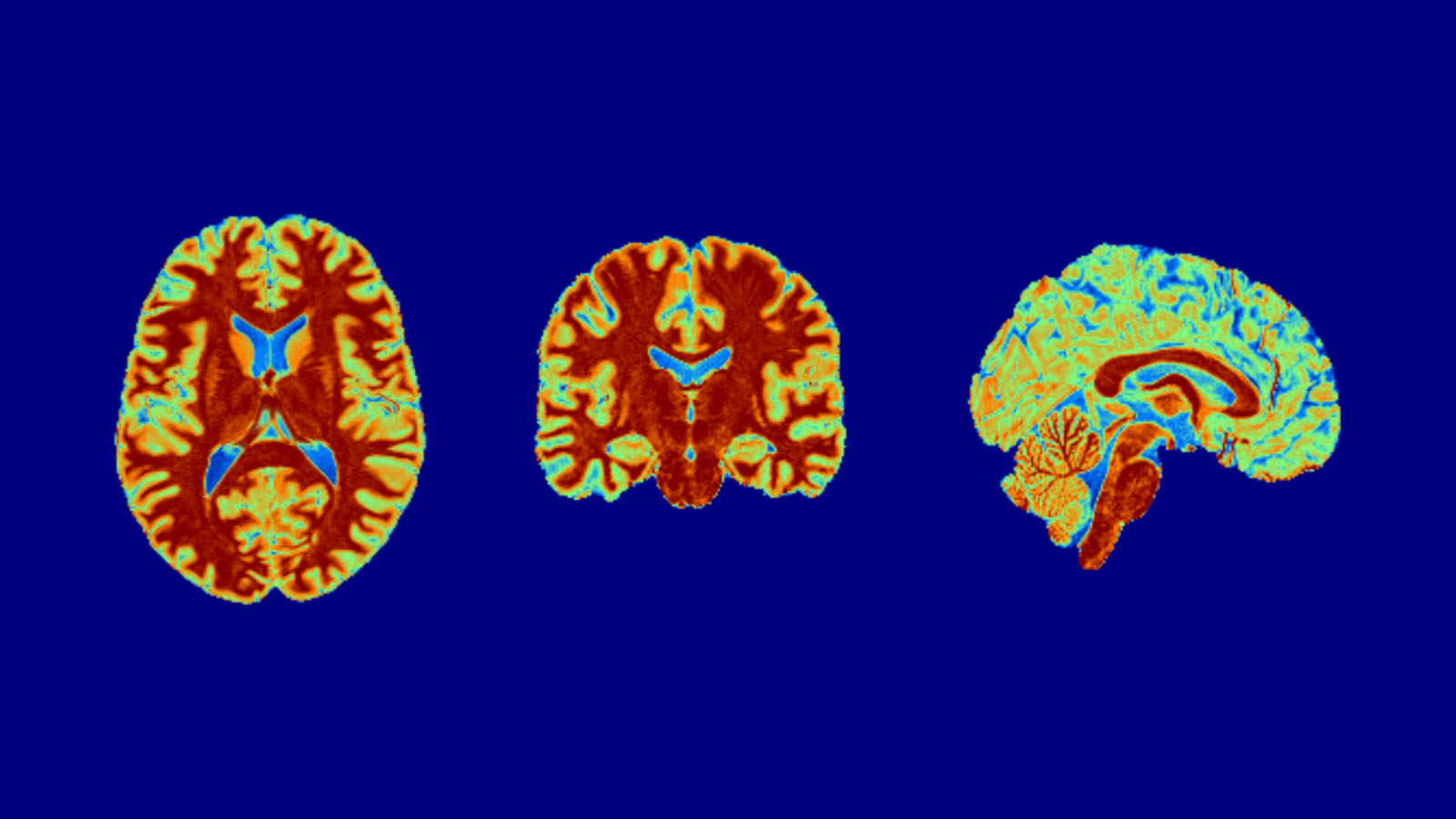 Structural brain scan